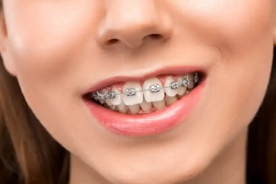 dental braces in abu dhabi